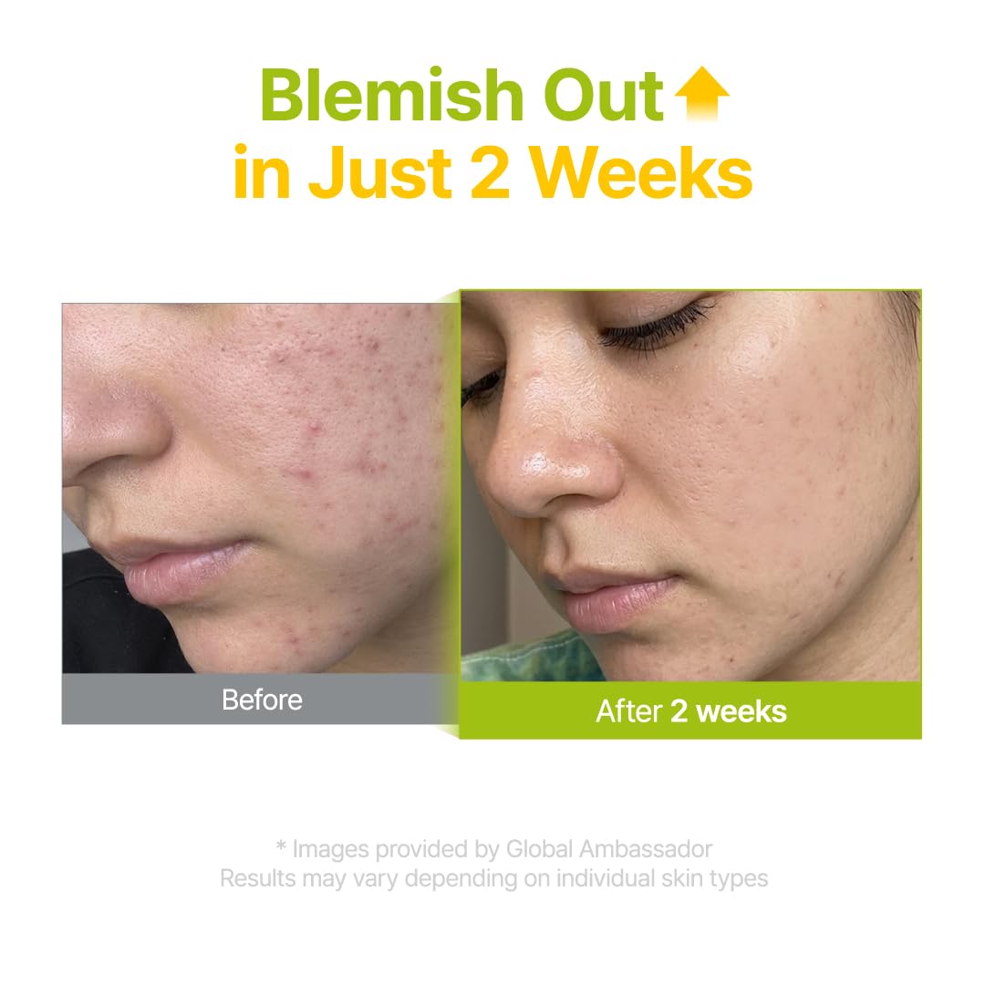 Azelaic 10% Kojic Serum for Sensitive Skin